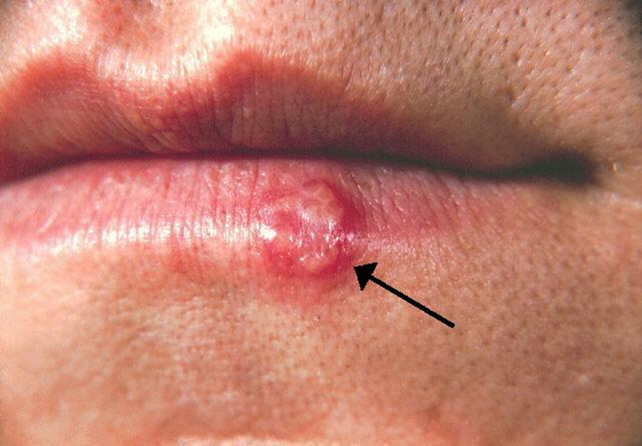 Groundbreaking Research Links Cold Sore Virus to Alzheimer’s Disease Risk